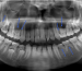 Caso de éxito Dental Image Oligodoncia